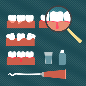 The most common cause of bleeding gums is gingivitis. 
