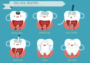 root canal illustration