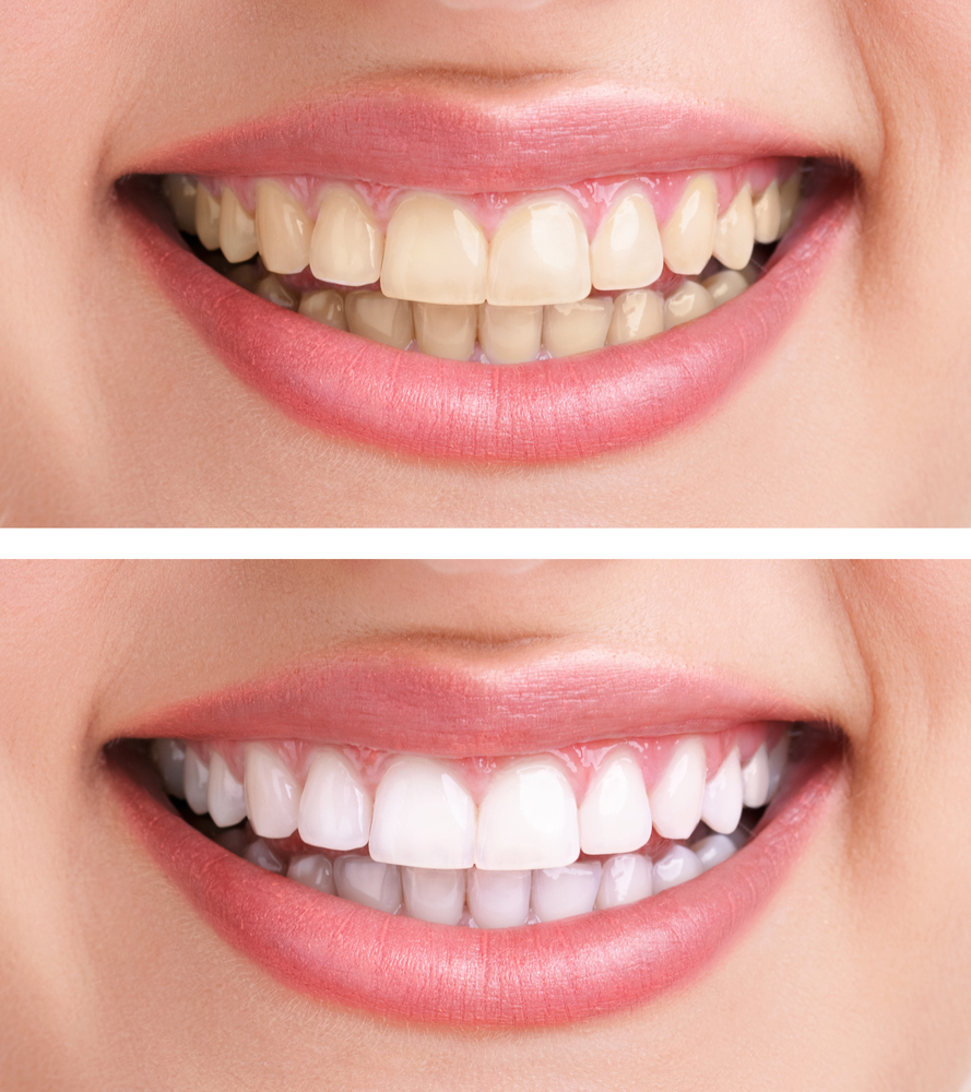5 Dental Care Tips for a Sparkling Smile